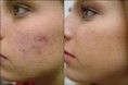 Curativo de Acne